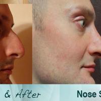 rhinoplastyspecialist